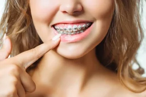 Dental insurance for braces